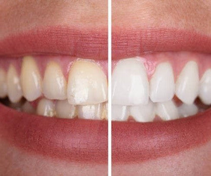 SparkleSmile™ | Feel more confident with a fresh, radiant smile that lasts